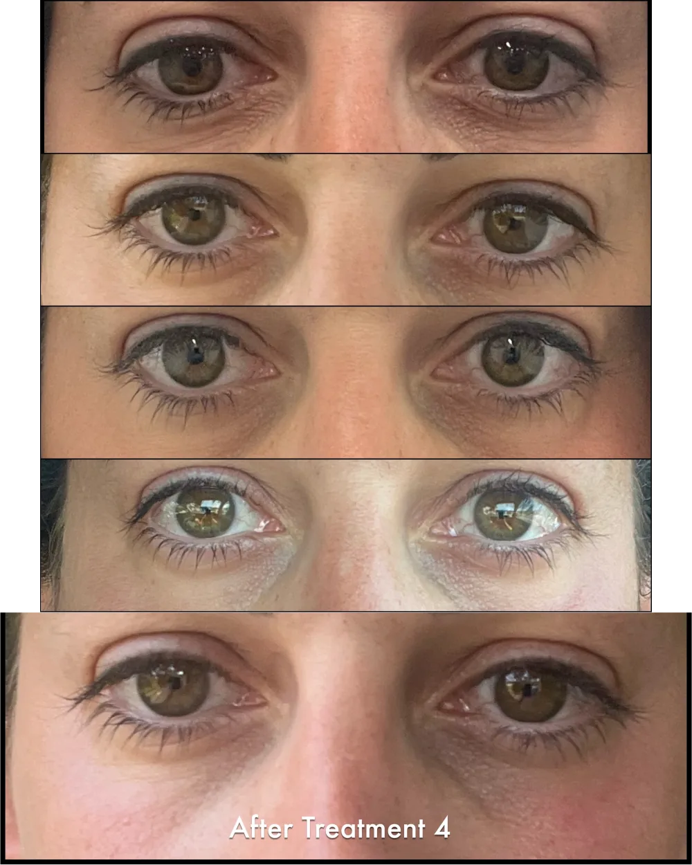Under-eye area before OptiLift and after each of four treatments