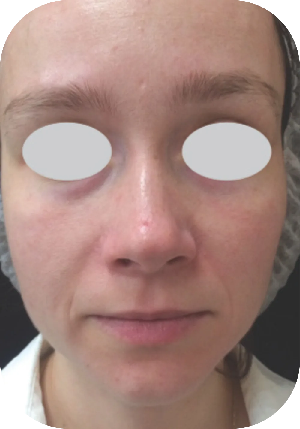 After IPL treatment for rosacea, reduced facial redness