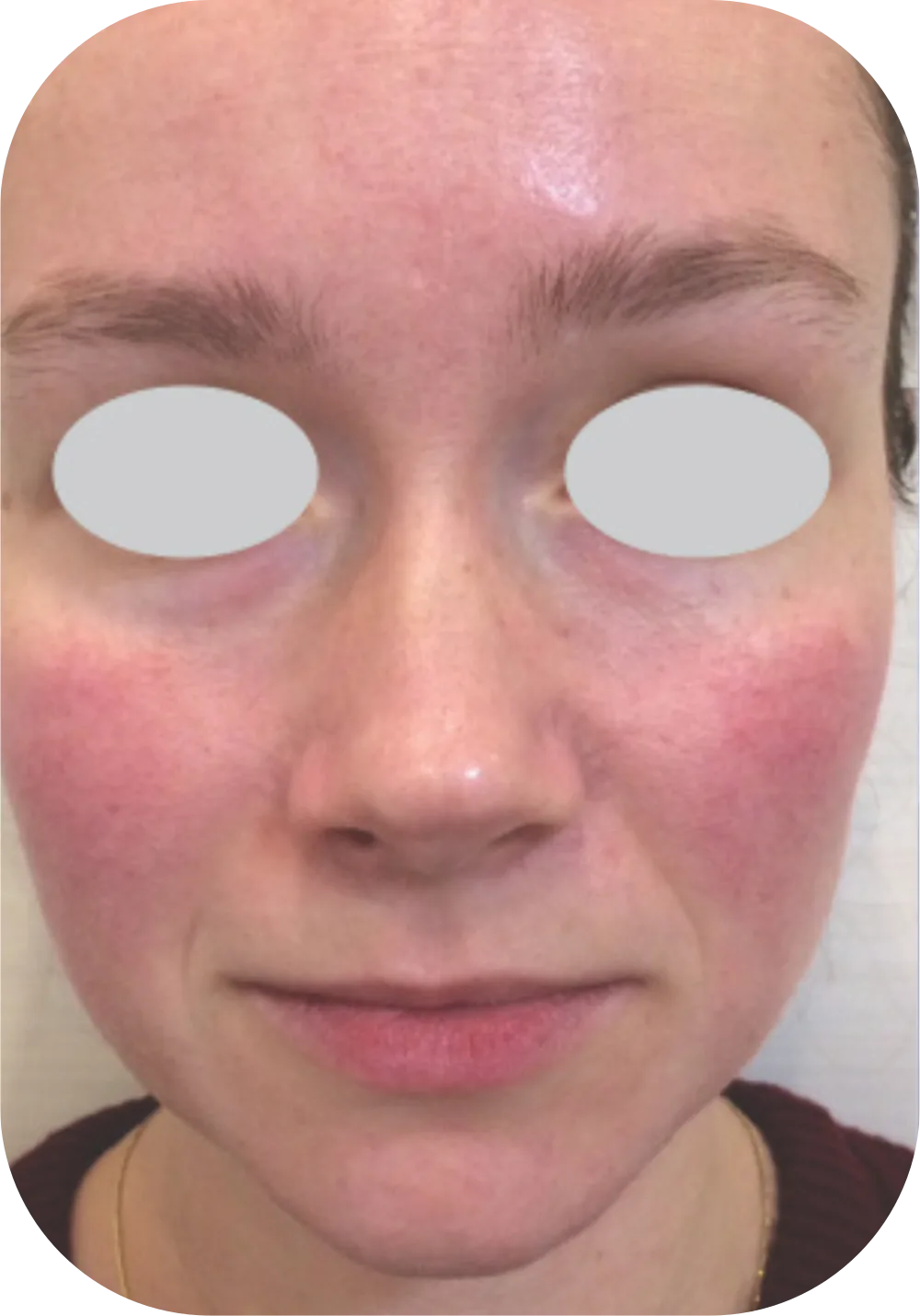 Before IPL treatment for rosacea, facial redness