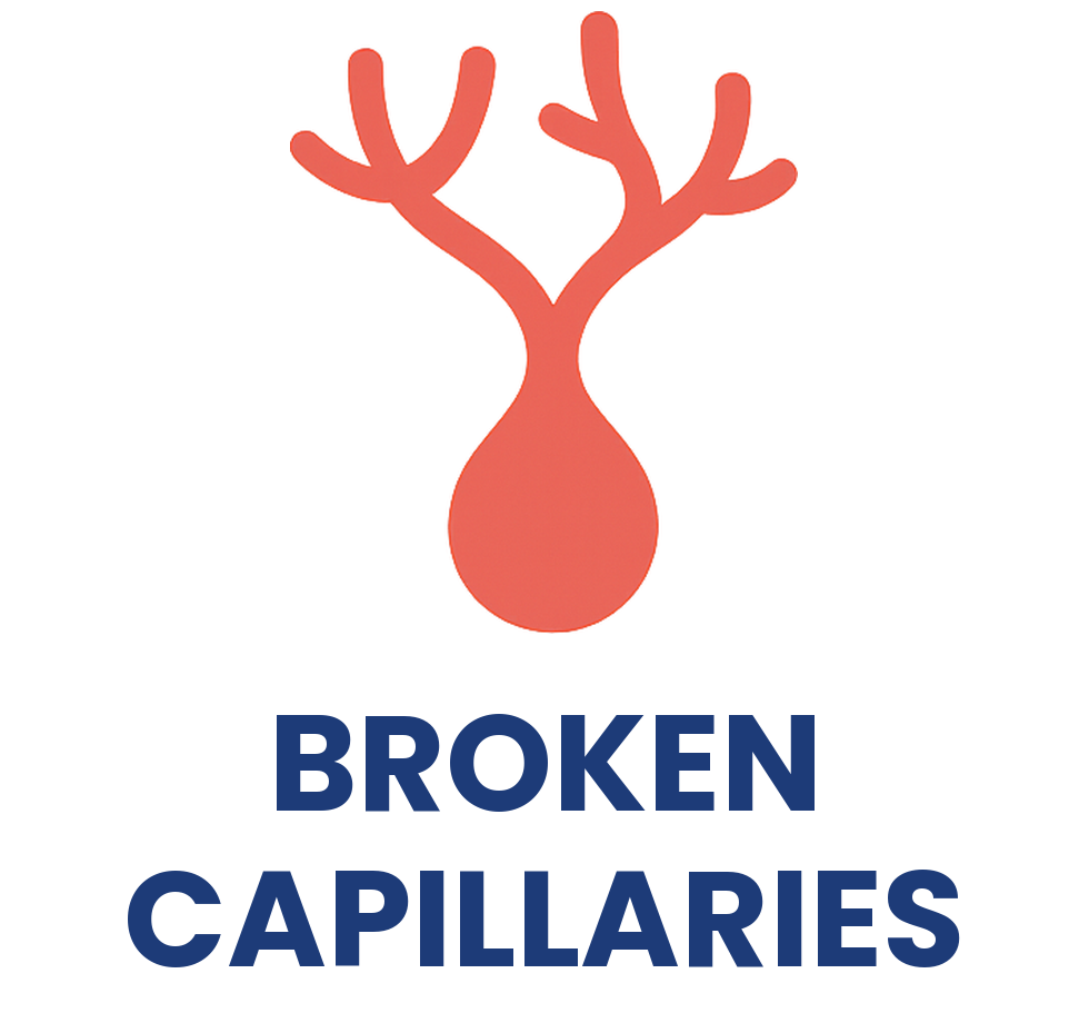 Broken capillaries treatment