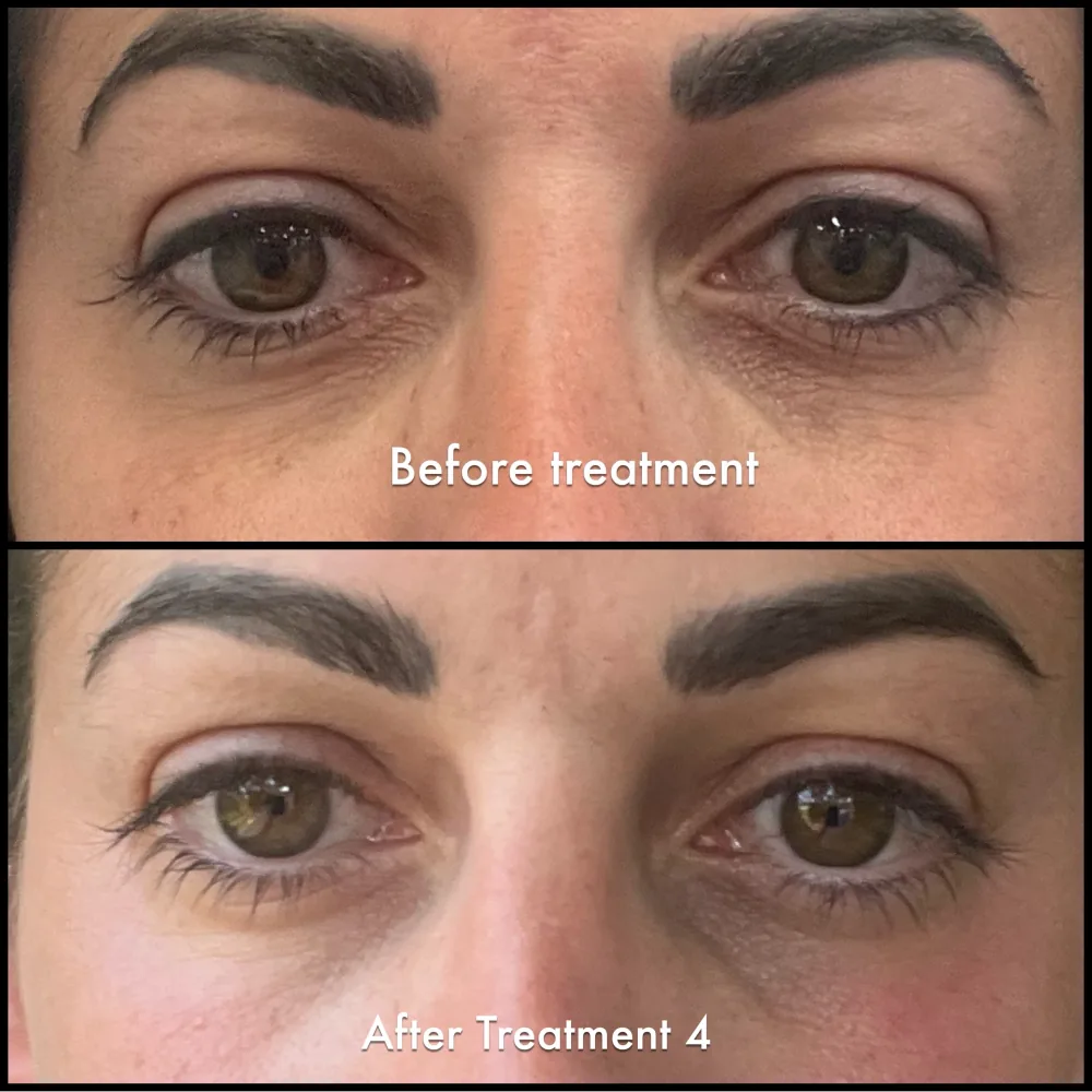 Eyelids before and after four OptiLift treatments